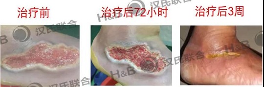 漢氏聯(lián)合干細(xì)胞治療糖尿病足