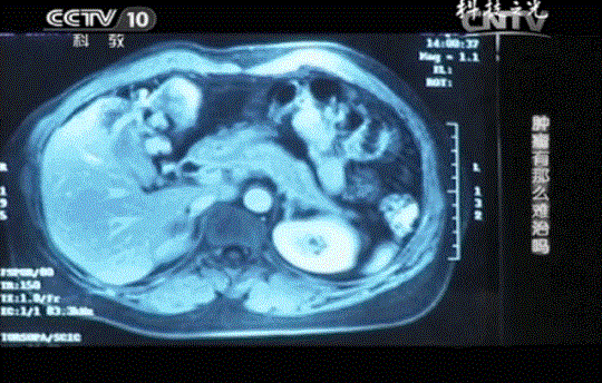 存儲(chǔ)免疫細(xì)胞有用嗎? 存儲(chǔ)免疫細(xì)胞有用嗎?