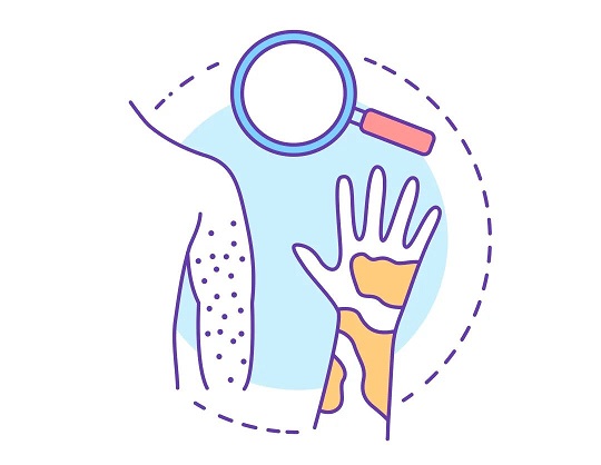 免疫細胞治療濕疹 免疫細胞治療濕疹