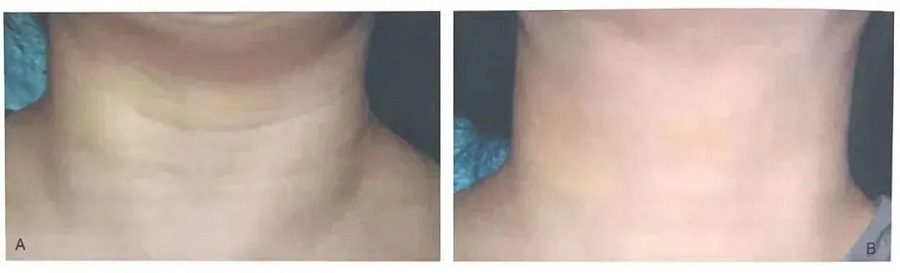 干細(xì)胞抗衰 干細(xì)胞抗衰